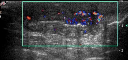 Figure 5 for case Hidradenitis suppurativa